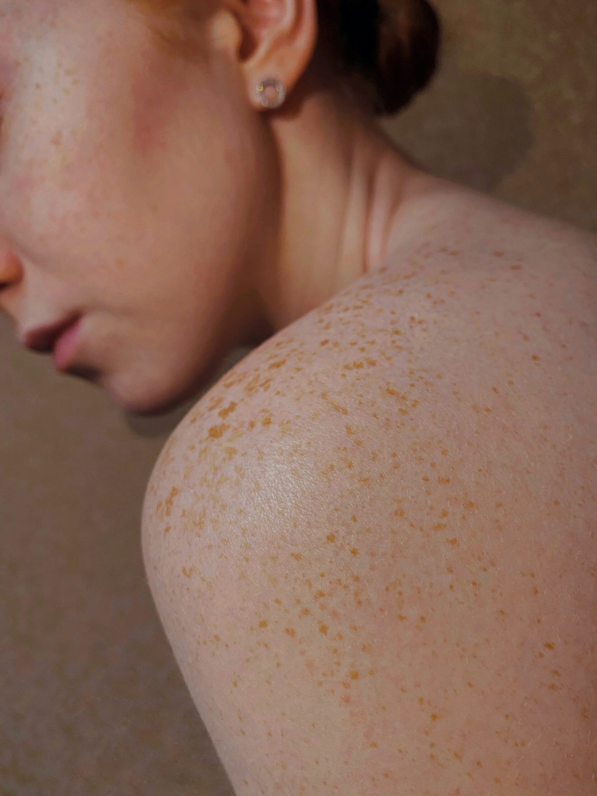 Close-up of sun-exposed freckled shoulder, showing skin sensitivity to UV rays in New Zealand